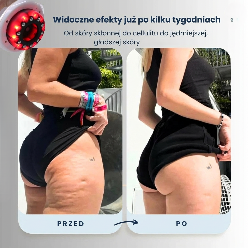Masażer Celutio - Pozbądź się celulitu!
