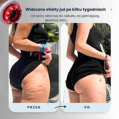 Masażer Celutio - Pozbądź się celulitu!